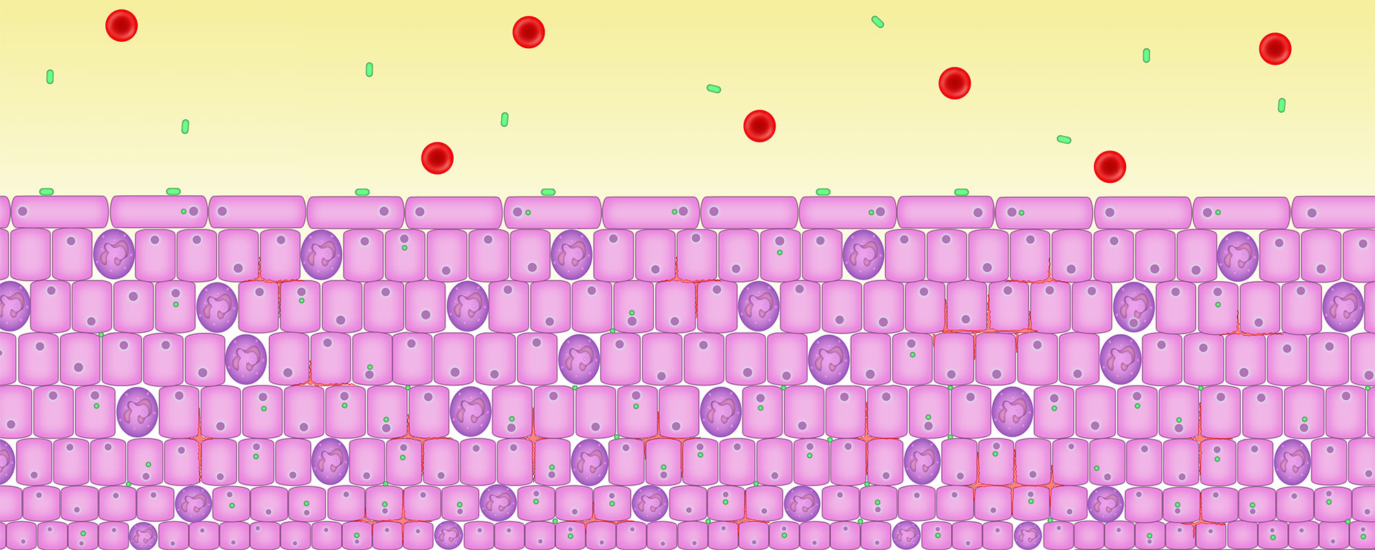 Persisting inflammation causes the urothelium to thicken