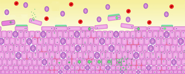 a chronic UTI in action - illustration of what it looks like under a microscope